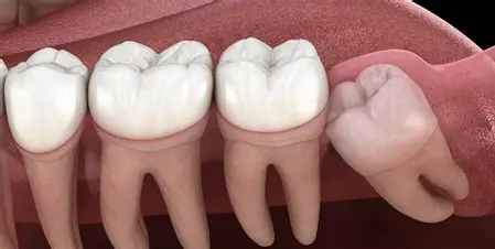 Impaction