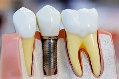 Implant